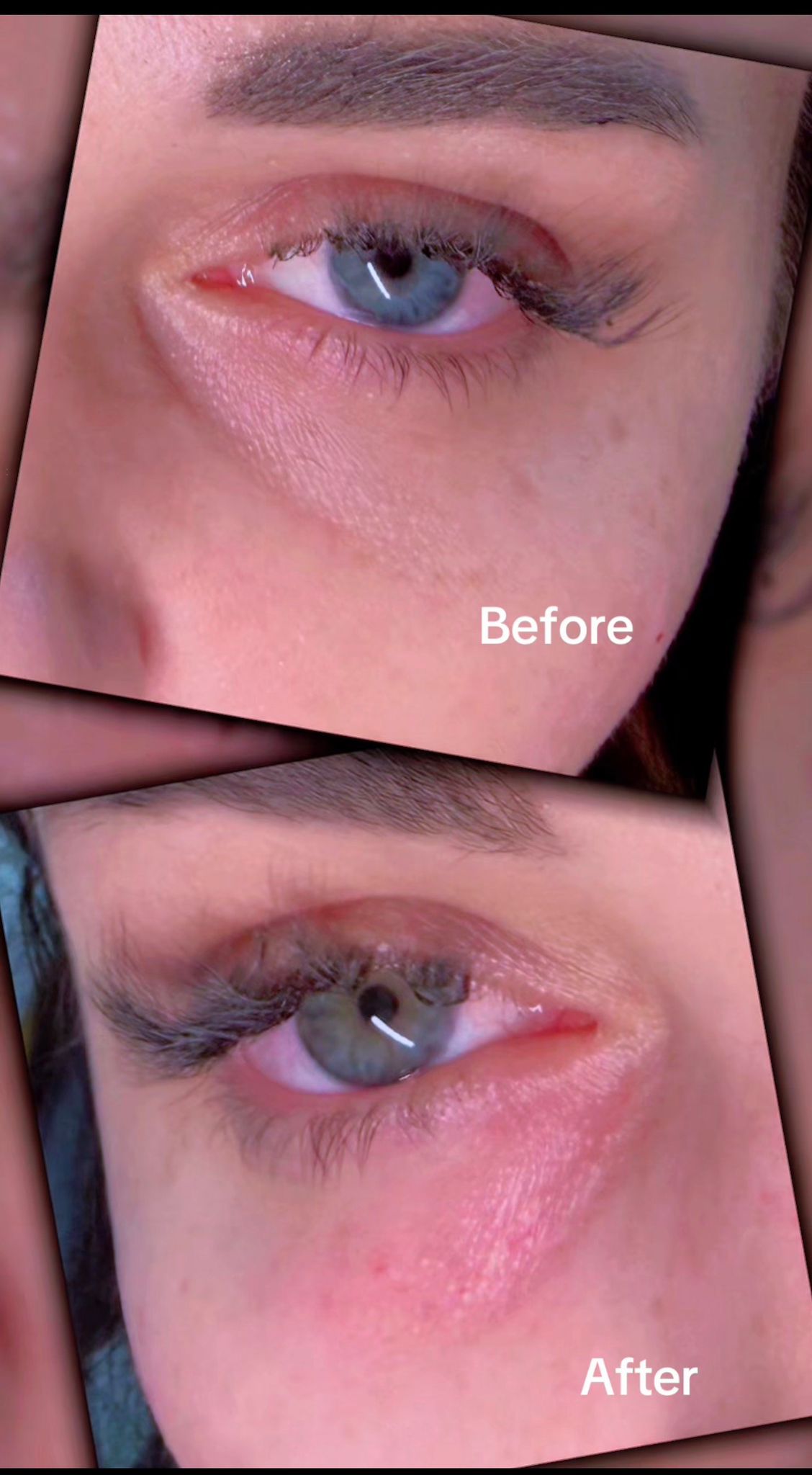 Under Eye Treatment